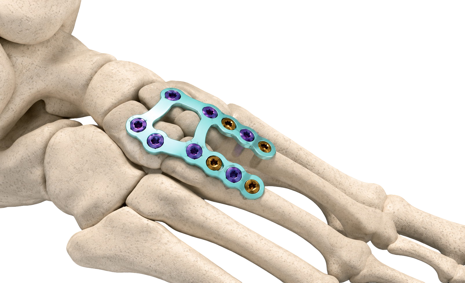 ALLFIT LISFRANC PLATE
